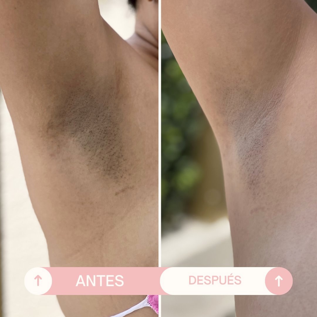 Antes y después Despigmentación axilas