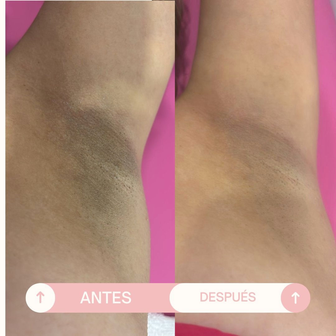Antes y después Despigmentación rodillas