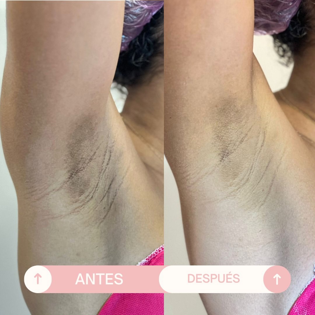 Antes y después Despigmentación